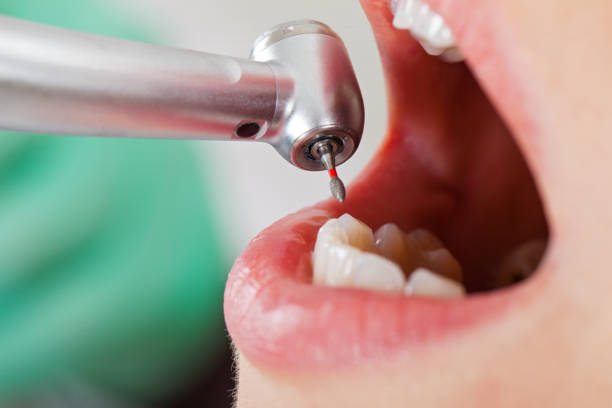 Best Emergency Treatment for Toothache in Columbia, MO
